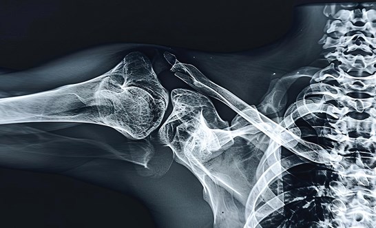 Understanding your workers’ compensation rights for musculoskeletal injuries